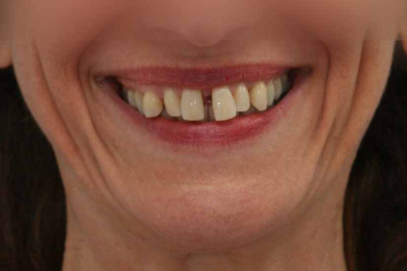Sourire dents avant le traitement Invisalign