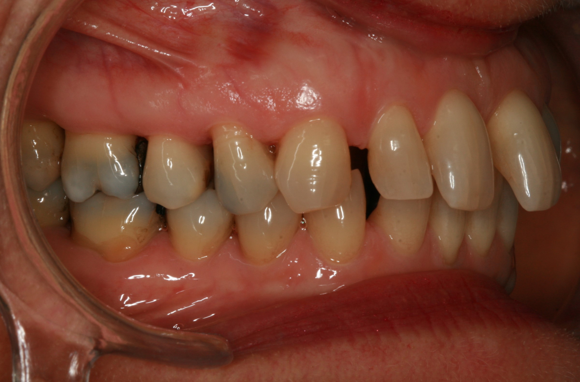 Dentition de trois quarts avant le soin Invisalign