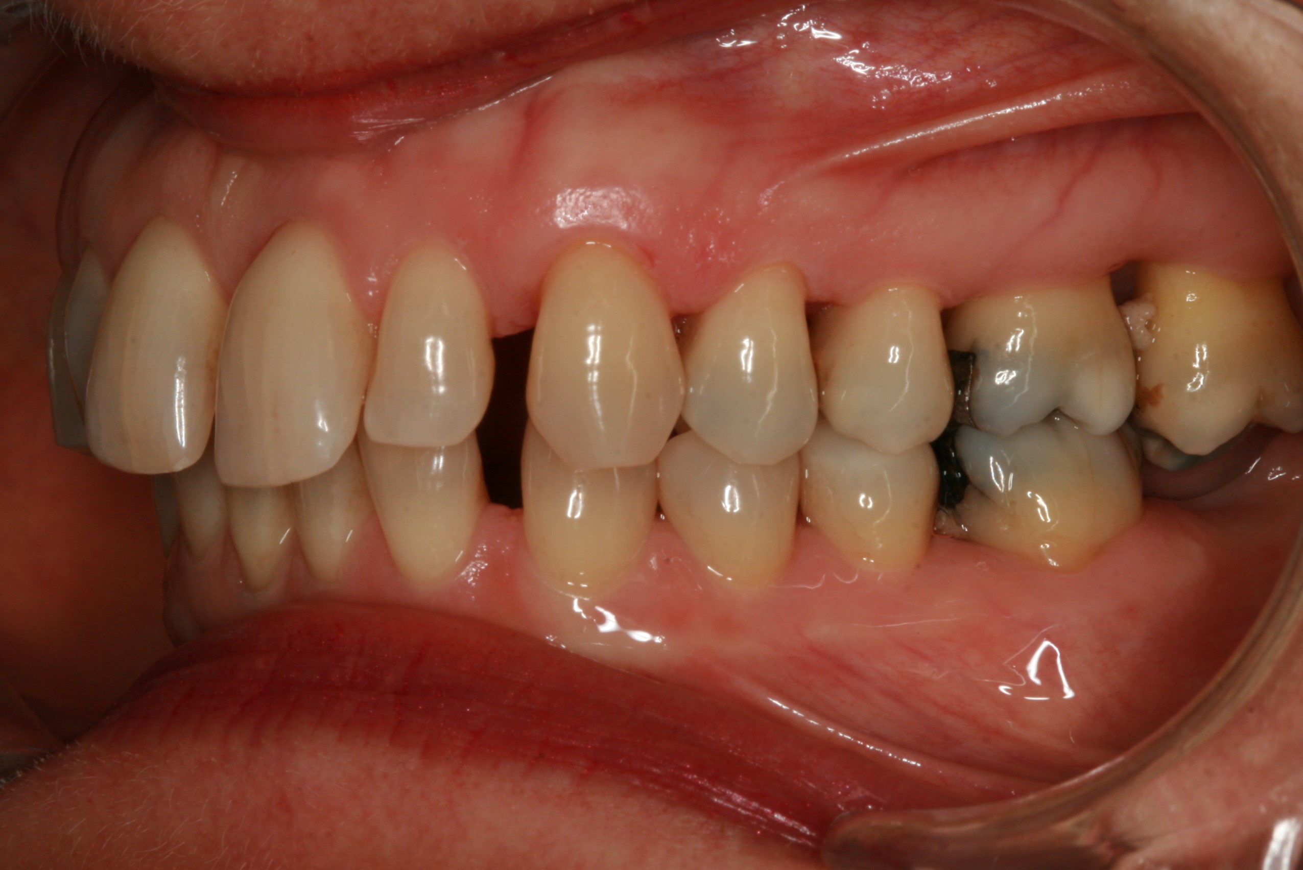 Dentition de trois quarts avant le soin Invisalign 1