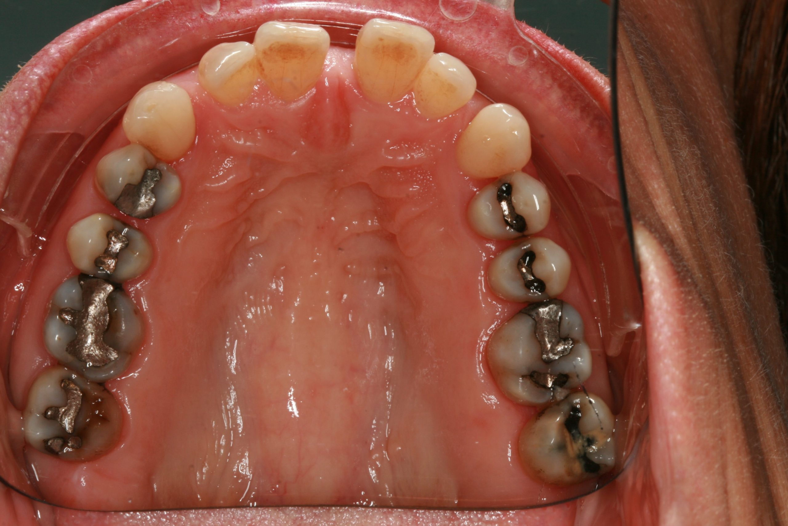 Dentition vue d'en bas avant Invisalign