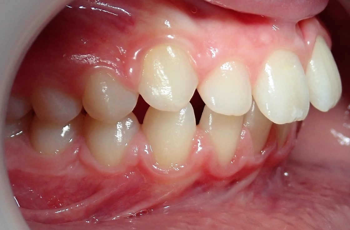 Dentition de trois quarts avant les soins 1
