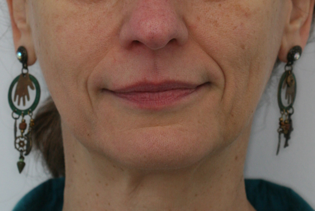 Sourire de face après le soin Invisalign adulte