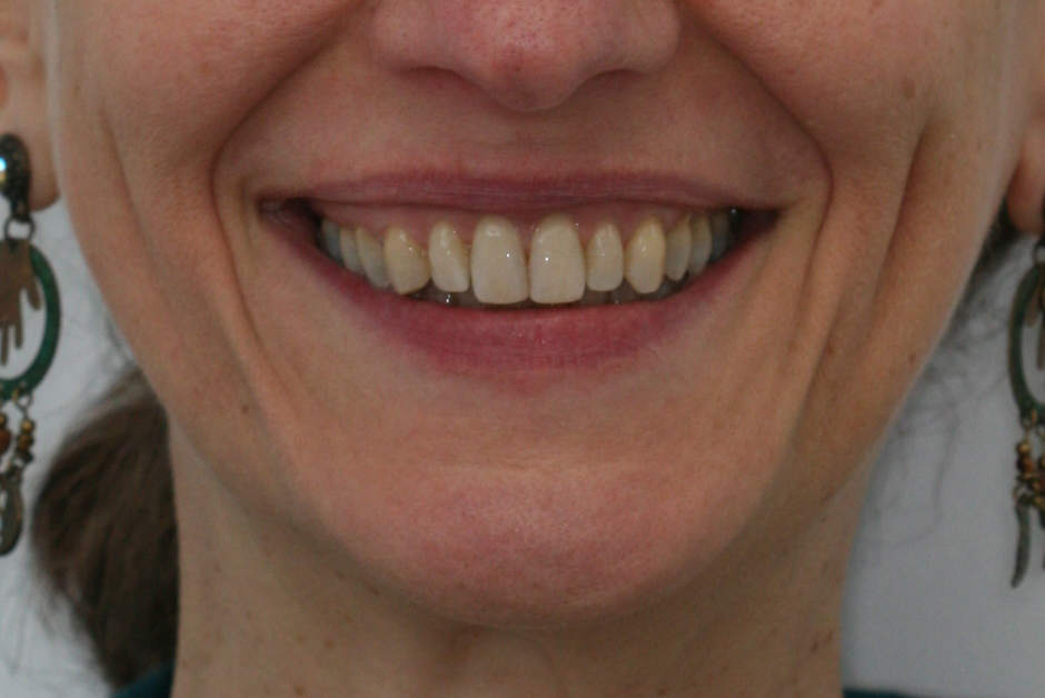 Dents après le traitement Invisalign adulte