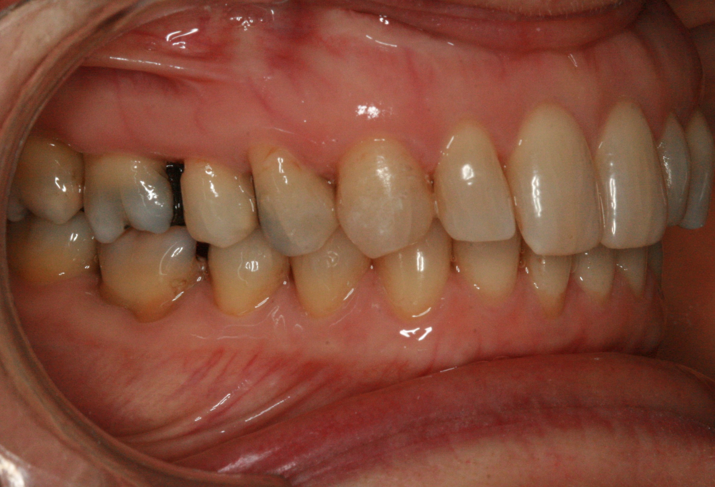 Dentition de trois quarts après Invisalign adulte