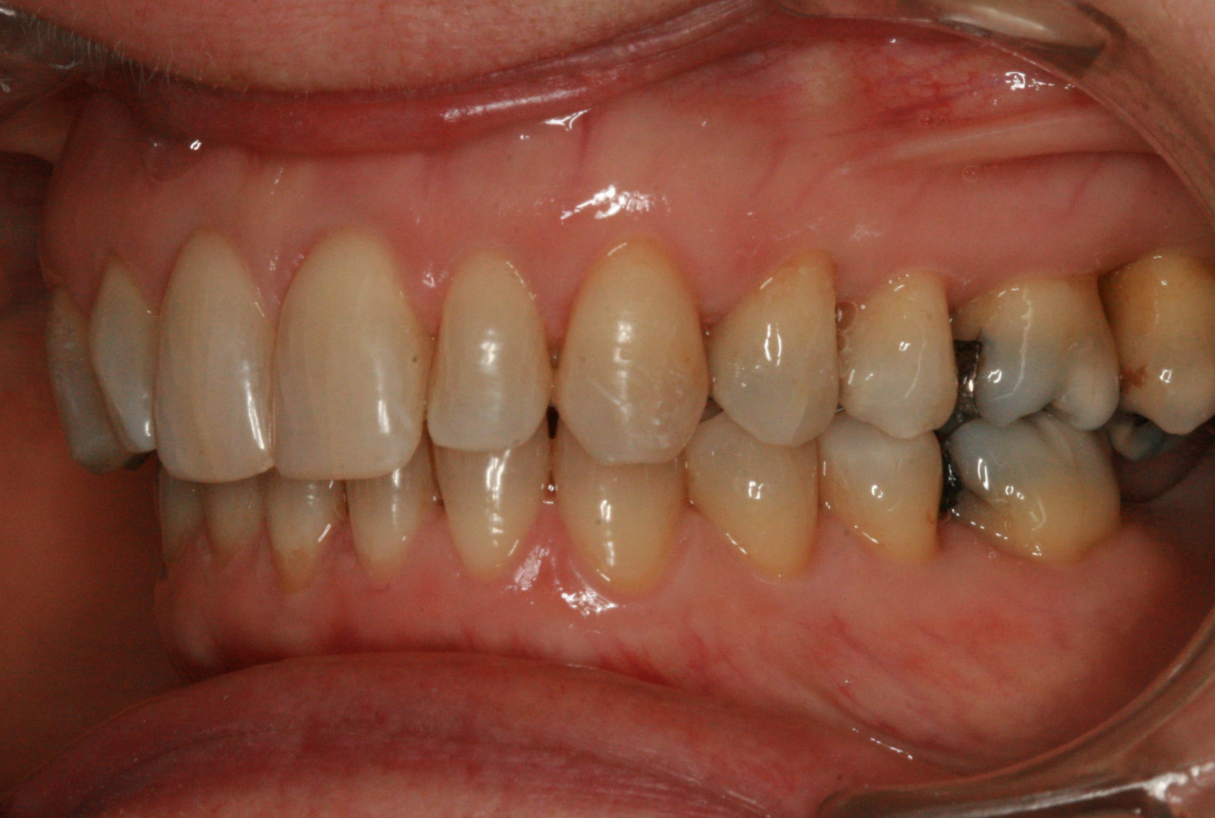 Dentition de trois quarts après Invisalign adulte 1