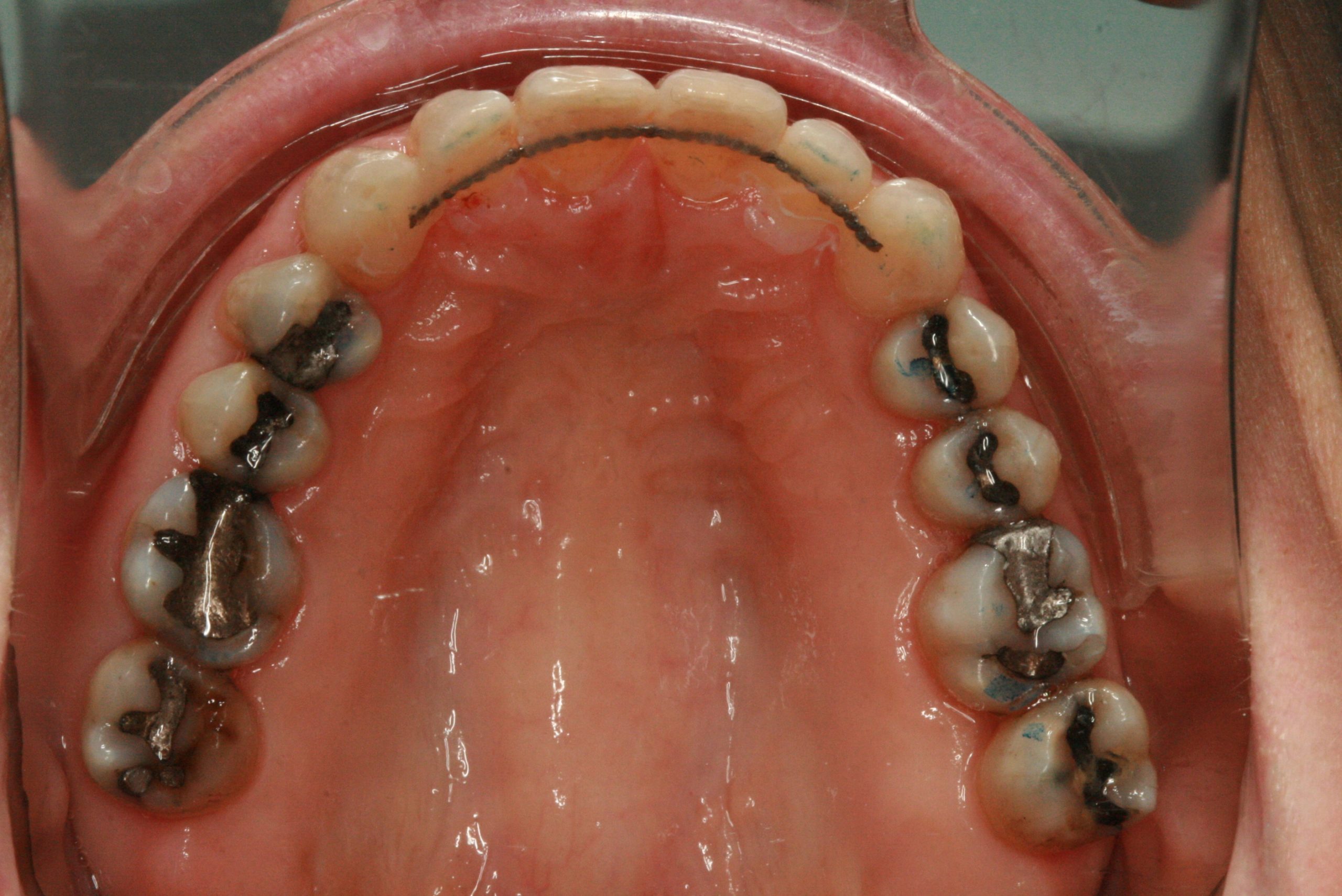 Dentition vue d'en bas grâce à Invisalign adulte