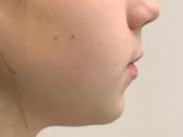 Traitement Invisalign de profil adolescent