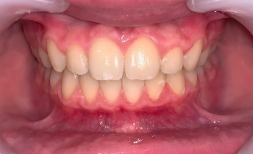 Dentition avec Ivisalign de face adolescent
