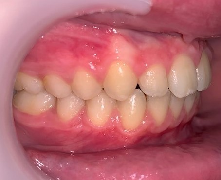 Dentition après le traitement de trois quarts adolescent 1
