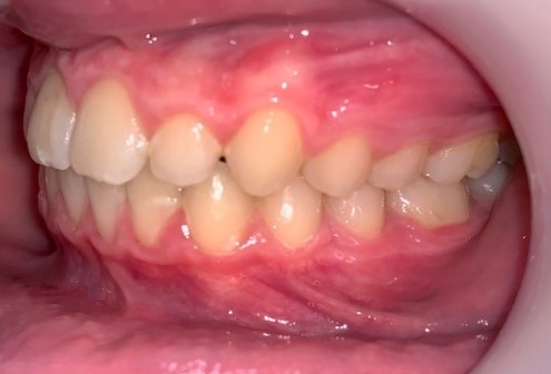 Dentition après le traitement de trois quarts adolescent