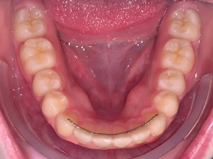 Dentition vue d'en haut avec Invisalign adolescent