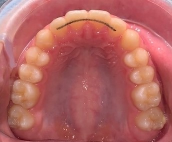 Dentition vue d'en bas avec Invisalign adolescent